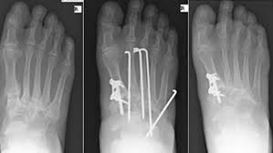 Arthrose Fusswurzel Vulpius Klinik