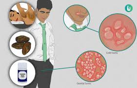 The world health organization had released its first ever global estimate of people contracting and getting infected with herpes a few years back. Ayurvedic Treatment Medicines Remedies Herbs For Herpes Types Effectiveness And Risks