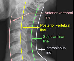 Image result for Spinal Trauma