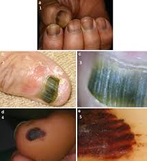 Image result for Acral lentiginous melanoma nail