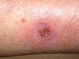 Also, while cuts and scrapes do hurt, if you have an infection you may also notice more more discomfort and/or pain around the wound than you would normally feel. Wound Infection Dermnet Nz