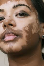 Revised classification/nomenclature of vitiligo and related issues: Elisabetha Van Aalderen Ihre Fotos Feiern Die Schonheit Von Vitiligo Brigitte De