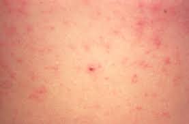 Image result for scabies effects on the human body