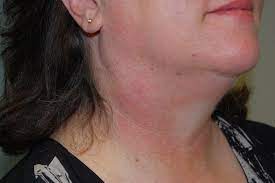 Throat cancer causes, signs and symptoms. Neck Lumps Dr John Chaplin Head And Neck Surgeon