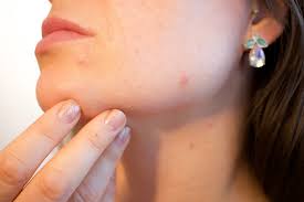 A quick and easy recipe for hair growth mask: Brewer S Yeast Benefits For Perfect Skin Get Rid Of Acne