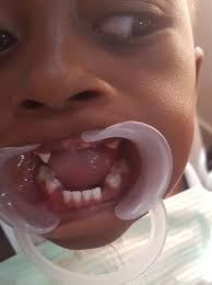 INFANT ORAL MUTILATION (IOM)