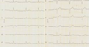 How to interpret the ecg / ekg: Leistungsknick Thoraxschmerz Und Polyserositis Bei Einem 35 Jahrigen Patienten Mit Antikonvulsiver Therapie Springerlink
