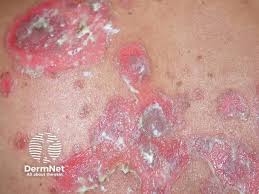 Image result for Pemphigus