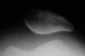 Image result for Patellar Tilt Test