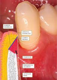 An Overview Of Periodontal Regenerative Procedures For The General Dental Practitioner Sciencedirect