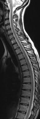 Check spelling or type a new query. Mrt Hws Bws T2 Gewichtet Sagittal