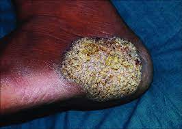 Tuberculosis is curable and preventable. Tuberculosis Verrucosa Cutis Presenting As A Solitary Verrucous Plaque Download Scientific Diagram