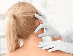 An excisional biopsy removes the entire tumor (red cells) and nearby healthy tissue (tan cells). When Your Dermatologist Says Skin Biopsy What Does That Mean My Doctor Online