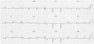 An abnormal ekg means that there is something unexpected in the ekg reading. Poor R Wave Progression Prwp Litfl Ecg Library Diagnosis