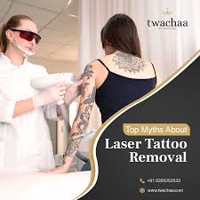 The top 5 best laser tattoo removal machines 2021. What Are The Top Myths About Laser Tattoo Removal