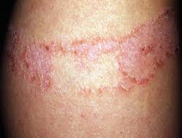 Sunscreen woes november 6, 2018 11:50 pm subscribe. Allergic Contact Dermatitis Dermnet Nz