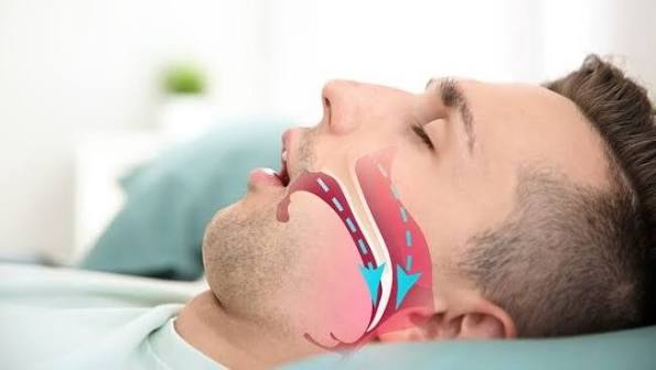 Bài 1: Ngáy to có phải ngủ ngon? Chuyên gia cảnh báo nguy cơ ngưng thở khi  ngủ