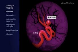 A brain aneurysm can result from a congenital defect, some inherited diseases, or other degenerative conditions, such as hypertension (high blood pressure) or atherosclerosis (fat buildup inside the arteries, often leading to heart attack or stroke). Health In Focus Brain Aneurysm 9 10 News