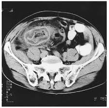 Image result for Neutropenic Colitis