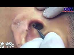 Pin On Dr Pimple Poper