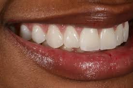 Veneers Vs Lumineers Best Dentists In Los Angeles For Veneers