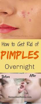 11 Effective Home Remedies To Get Rid Of Pimples And Acne Overnight At Home Here Are Th In 2020 How To Get Rid Of Pimples Pimples Overnight Overnight Pimple Remedies