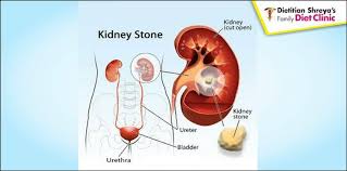 If You Have Kidney Stone Must Read Dietitian Shreya Facebook