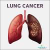 Cell type and stage are the most critical factors in determining the survival rate is the stage at the time of diagnosis. 1