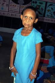 Image result for progeria case in bihar