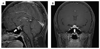 Partially Empty Sella Syndrome And Weight Gain