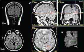 Romans chapter twelve has a similar listing of the gifts of the spirit but i corinthians chapter twelve is more comprehensive in nature. Neuroimaging In Epilepsy Chapter 17 Understanding Epilepsy