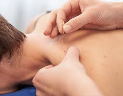 Dry Needling Clinic Serving Warriewood Mona Vale In Sydney