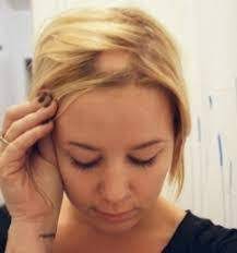 Here, we discuss its causes alopecia is a common form of hair loss. Ù…Ø§ Ù‡Ùˆ Ø¯Ø§Ø¡ Ø§Ù„Ø«Ø¹Ù„Ø¨Ø© Ø§Ù„Ø¨Ù‚Ø¹ÙŠØ© Alopecia Areata Ellearabia