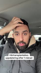 Hårtransplantation Uppdatering Efter 1 Månad