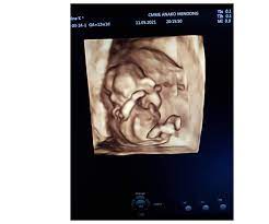 We did not find results for: 4d Ultrasound