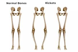 Image result for Rickets