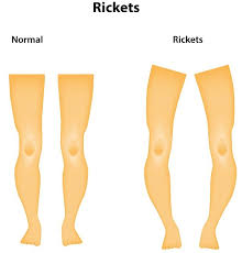 Image result for Rickets