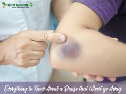 While bateman's is common, it is not dangerous. Everything To Know About A Bruise That Won T Go Away