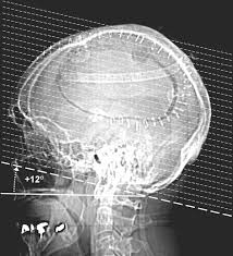 Image result for CT Head