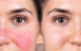 Also, taking a trip to the doctor for something common is a time and money waster. How To Get Rid Of Red Spots On Skin Nacach Wax