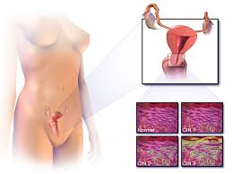 Cervical cancer is caused by the human papillomavirus (hpv). Cervical Cancer Wikipedia