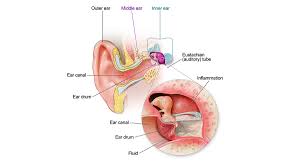 Ear infection treatment