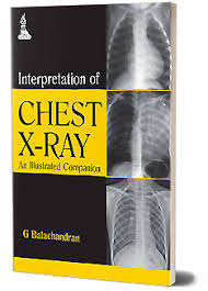 Image result for Chest XRay Interpretation