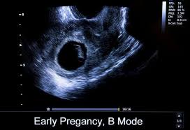 crl measurements in pregnancy