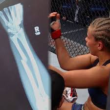 I bet the arm will be better in no time. Ufc On Fox Paige Vanzant Broke Her Arm At Ufc Stl Facebook