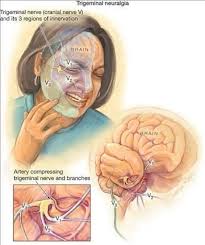 Pin On Trigemnial Neuralgia