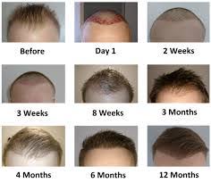 How long does the agagen stage last? How Long Does It Take To See Results From Hair Transplantation Cyber Hairsure