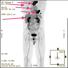 And may live for years past. Anaplastic Thyroid Cancer Diagnosis