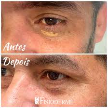 Image result for xantelasma