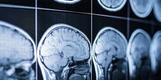 With that said, mris are better able to detect smaller intracranial hemorrhages than ct.12﻿﻿ besides identifying the location of blood in the brain, imaging tests are also able to determine the size of a bleed and whether a blood clothas formed. Gain A Better Understanding Of Brain Bleeds Parkridge Health System